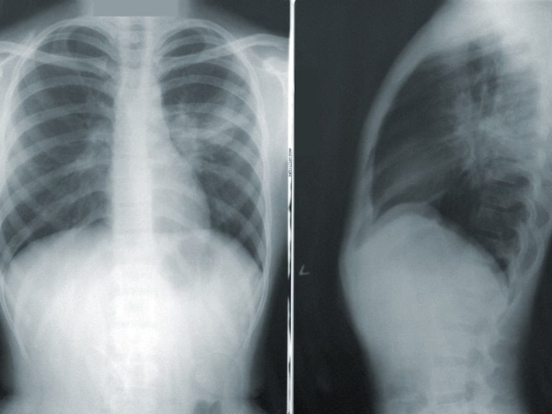Radiografía de tórax y torso — procedimientos intervencionistas guiados por imagen