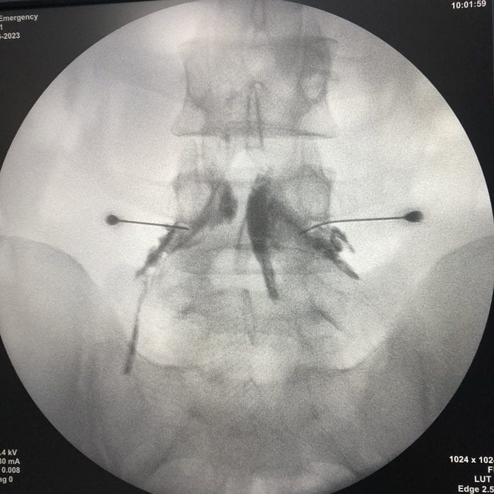 Fluoroscopia de un procedimiento intervencionista de dolor guiado por imagen