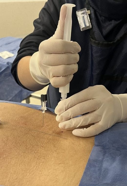 Infiltración guiada durante un procedimiento de dolor