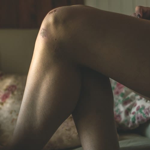 Primer plano de una rodilla, dolor articular